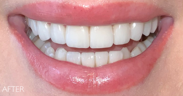 After — refreshed smile with porcelain veneers