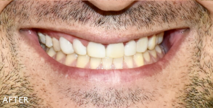 After — more even, balanced smile with veneers