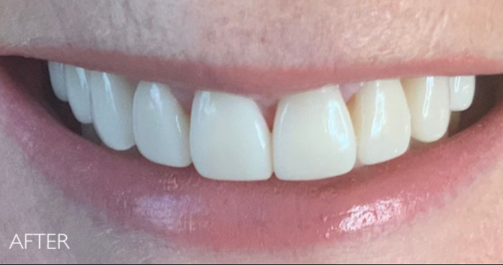 After — complete smile makeover with porcelain veneers