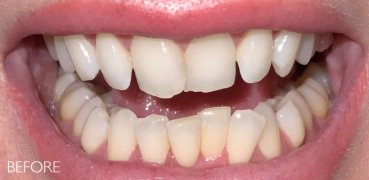 Before — chipped and worn front teeth prior to veneers