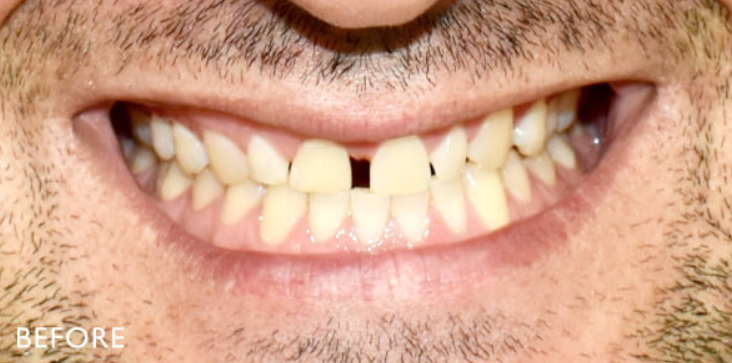 Before — gaps and uneven tooth shape prior to veneers