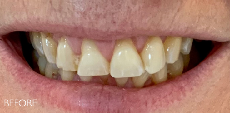 Before — discolored and irregular teeth prior to smile makeover